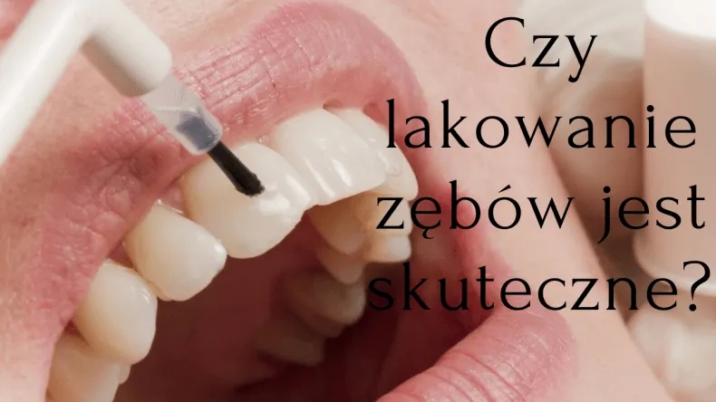 Co to jest lakowanie zębów i jak może uratować Twoje zęby?