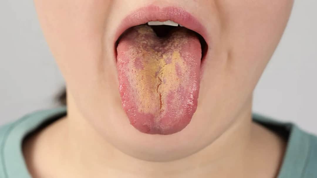 Alergia jamy ustnej objawy – jak uniknąć nieprzyjemnych dolegliwości