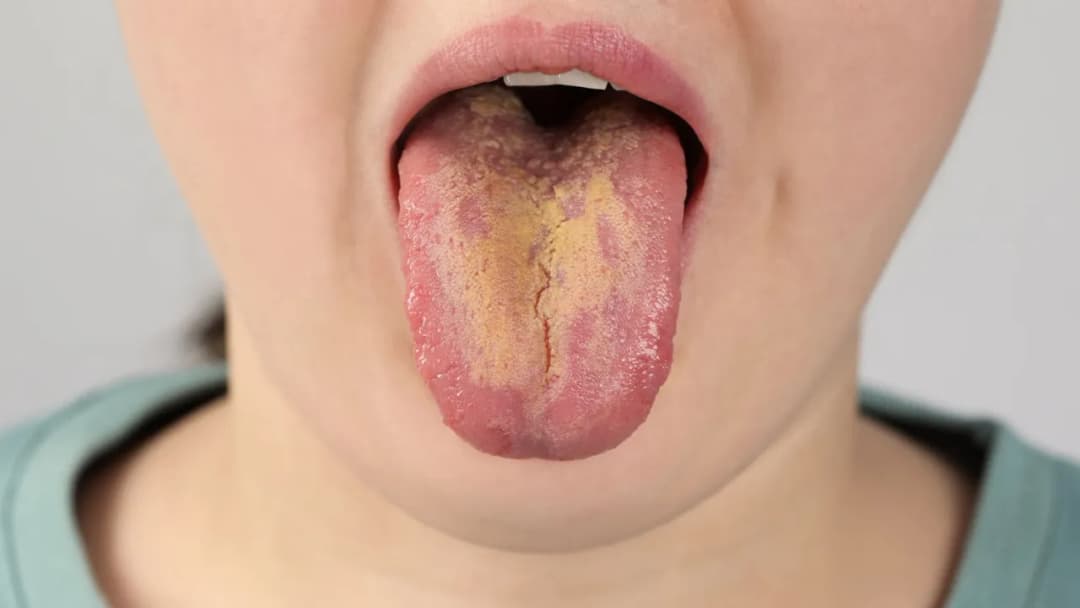 Alergia jamy ustnej objawy – jak uniknąć nieprzyjemnych dolegliwości Alergia jamy ustnej objawy – jak uniknąć nieprzyjemnych dolegliwości