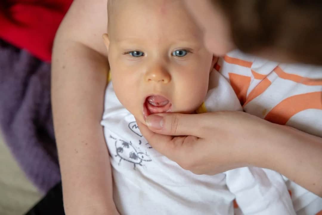 Jak wyglądają opuchnięte dziąsła u niemowlaka i co to oznacza?