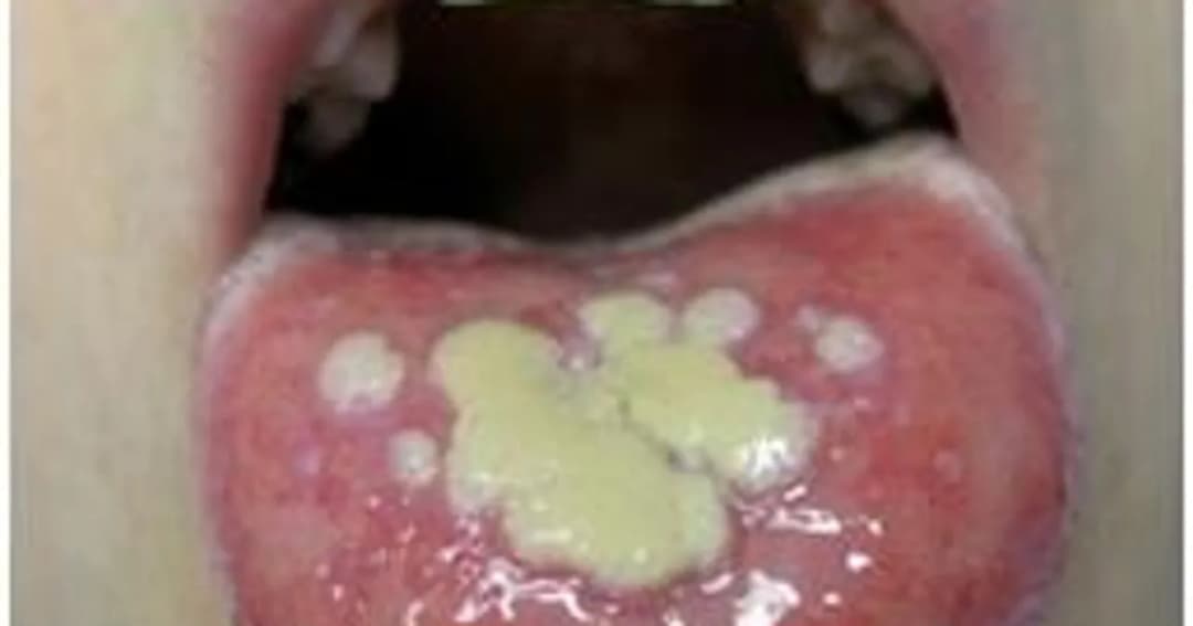 Jak wygląda afta w jamie ustnej? Objawy, które musisz znać