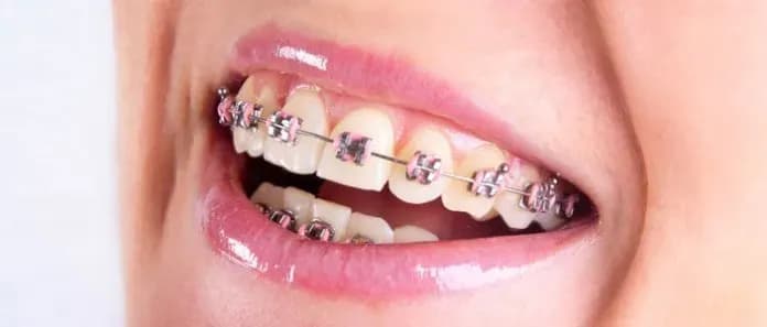 Czy aparat na zęby zmienia kształt twarzy? Oto, co musisz wiedzieć