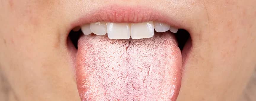Jak leczyć grzybicę jamy ustnej skutecznie i szybko – poznaj metody