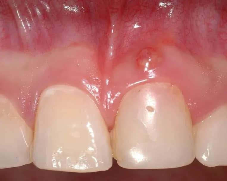 Jak wyglądają spuchnięte dziąsła u niemowlaka i co to oznacza?