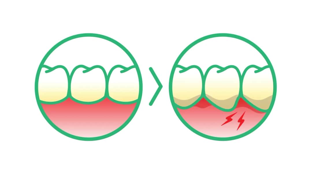 Dlaczego bolą dziąsła? Odkryj przyczyny i skuteczne rozwiązania