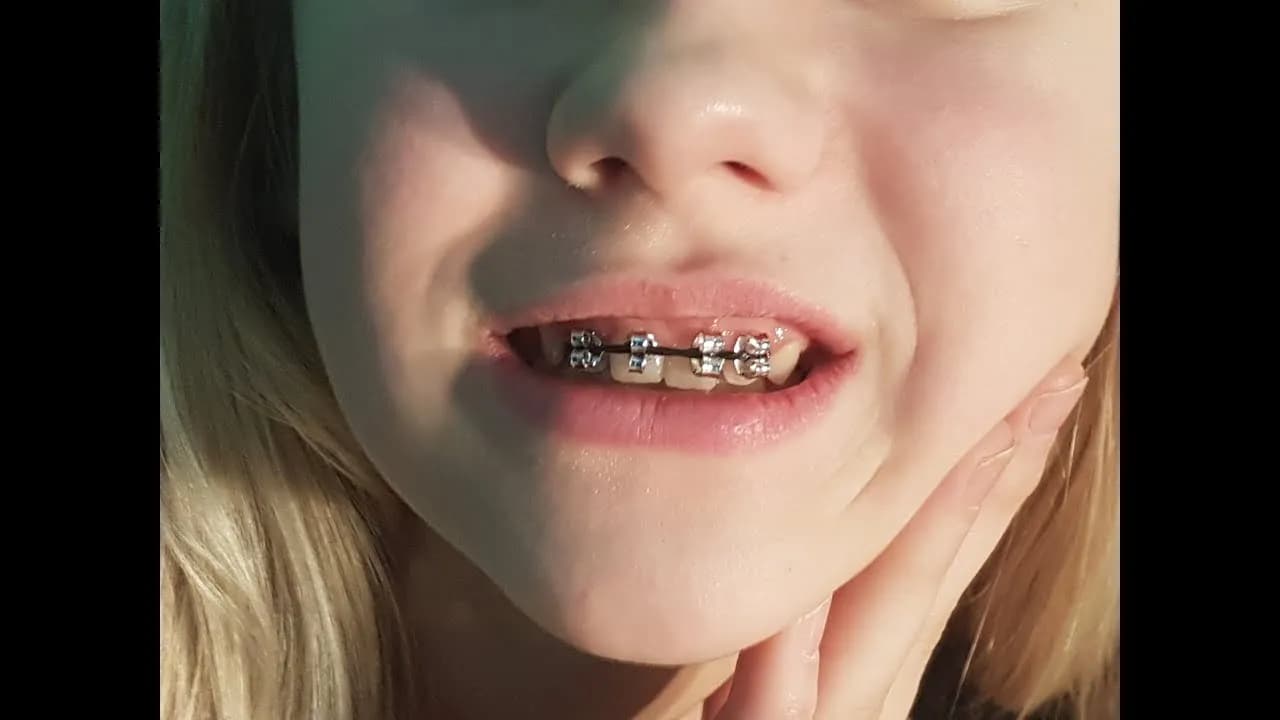 Jak zrobić sztuczny aparat na zęby w prosty sposób i z tanich materiałów