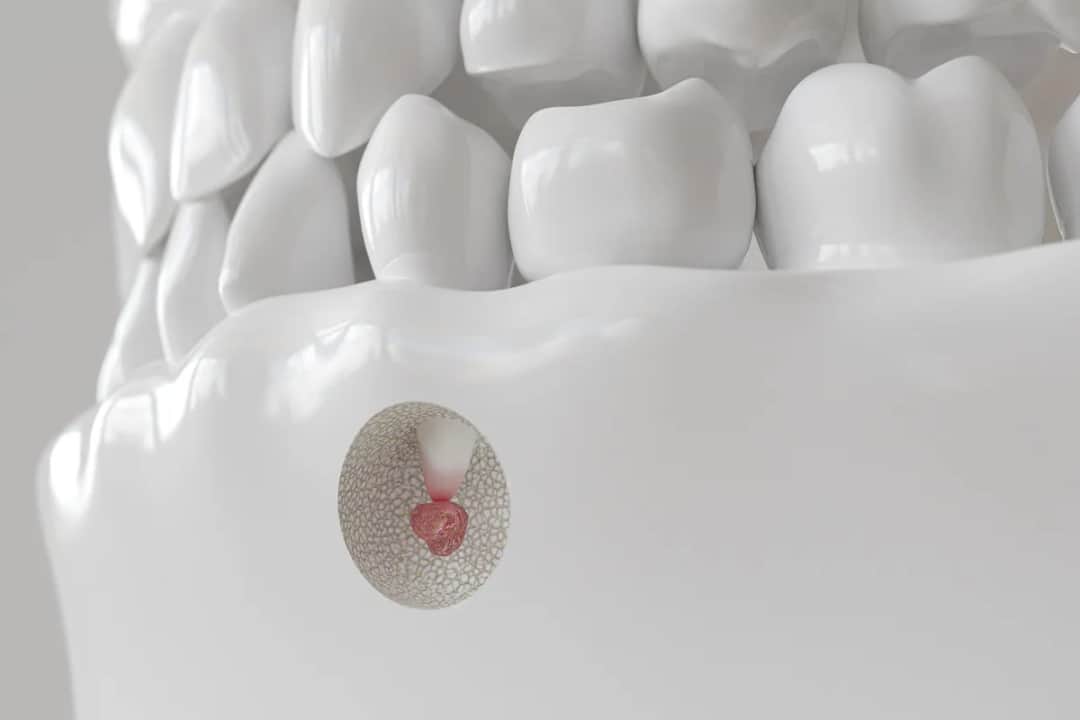 Ile kosztuje usunięcie korzenia zęba? Sprawdź, co wpłynie na cenę