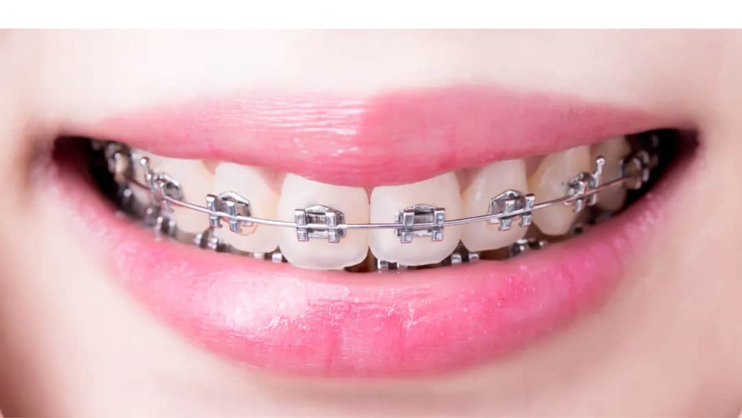 Kiedy założyć dziecku stały aparat na zęby, aby uniknąć problemów?