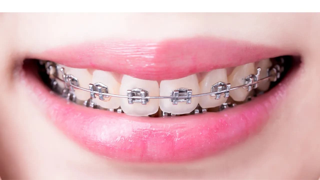 Kiedy założyć dziecku stały aparat na zęby, aby uniknąć problemów? Kiedy założyć dziecku stały aparat na zęby, aby uniknąć problemów?